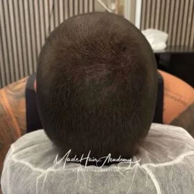 SMP Stockholm Tunnhår-fyllnad med hårpigmentering på man, 33 år, utförd hos Made Hair Academy i Stockholm – ledande klinik för diskret hårtatuering i Sverige