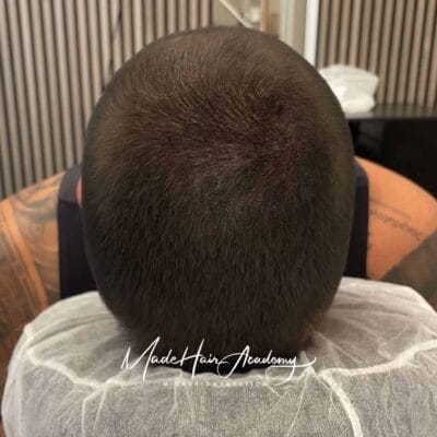 SMP Stockholm Tunnhår-fyllnad med hårpigmentering på man, 33 år, utförd hos Made Hair Academy i Stockholm – ledande klinik för diskret hårtatuering i Sverige