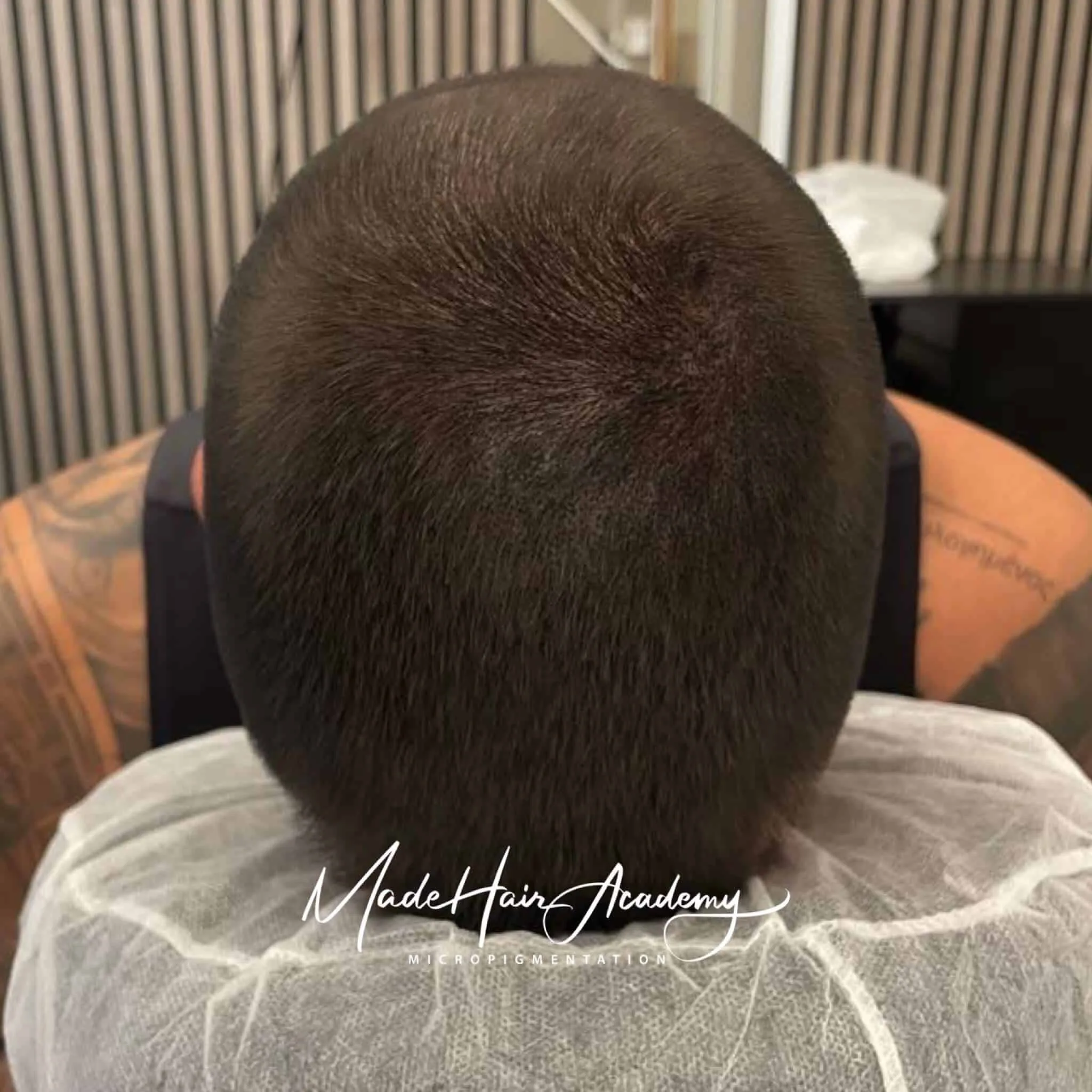 SMP Stockholm Tunnhår-fyllnad med hårpigmentering på man, 33 år, utförd hos Made Hair Academy i Stockholm – ledande klinik för diskret hårtatuering i Sverige