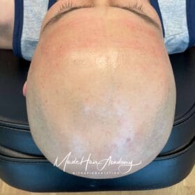 Tunnhårsfyllnad på man, 36 år, utförd hos Made Hair Academy i Stockholm – ledande klinik för diskret hårtatuering i Sverige