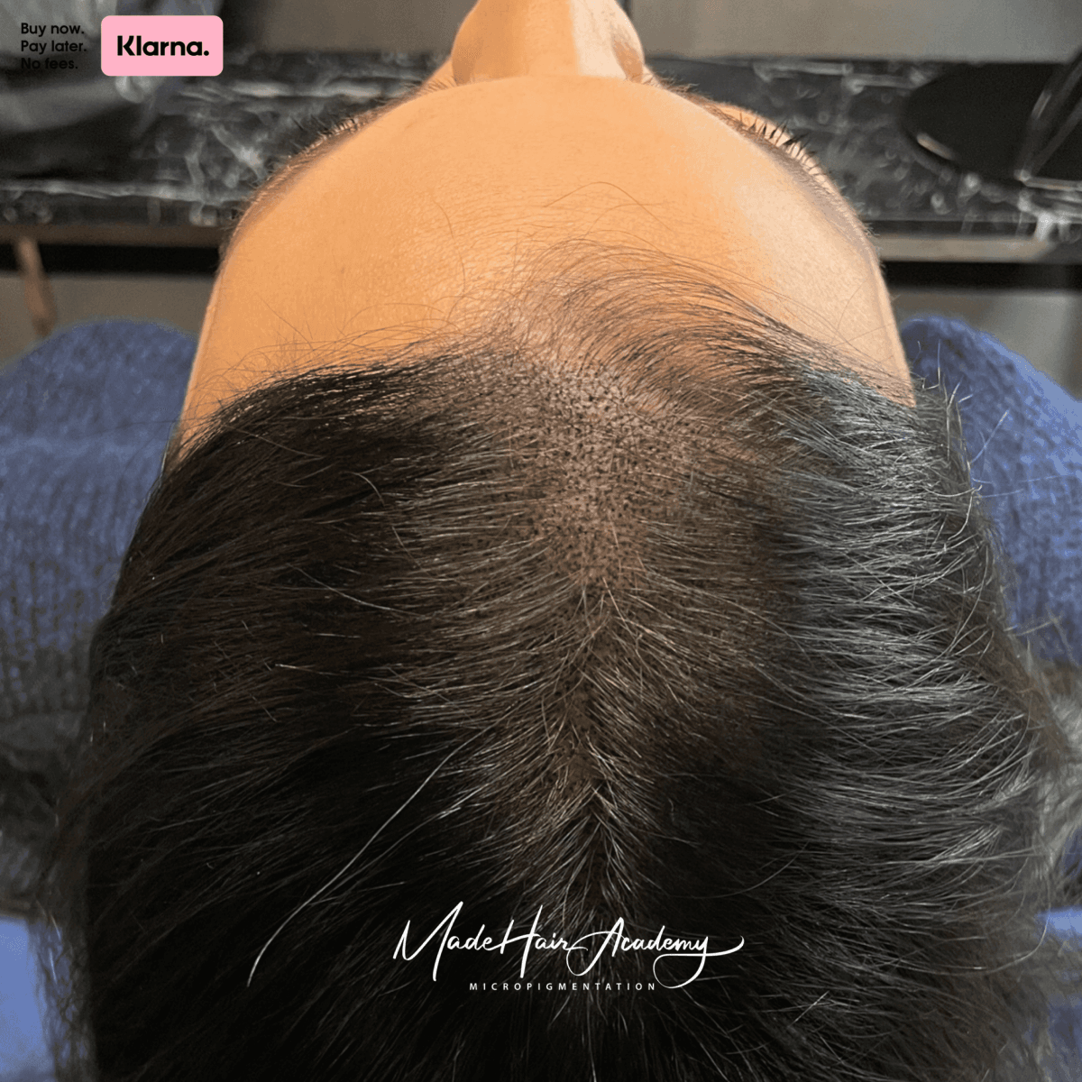 Scalp Micropigmentation, Hårpigmentering - Hårutfyllnad på kvinna, 28 år, i Göteborg – Naturligt resultat från Made Hair Academy.