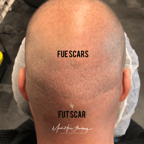 Scalp Micropigmentation, Hårpigmentering - Naturlig hårlinje med smp på man, 39 år, i Göteborg – Naturligt resultat från Made Hair Academy.