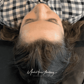 Scalp Micropigmentation, Hårpigmentering - Hårutfyllnad på kvinna, 28 år, i Göteborg – Naturligt resultat från Made Hair Academy.