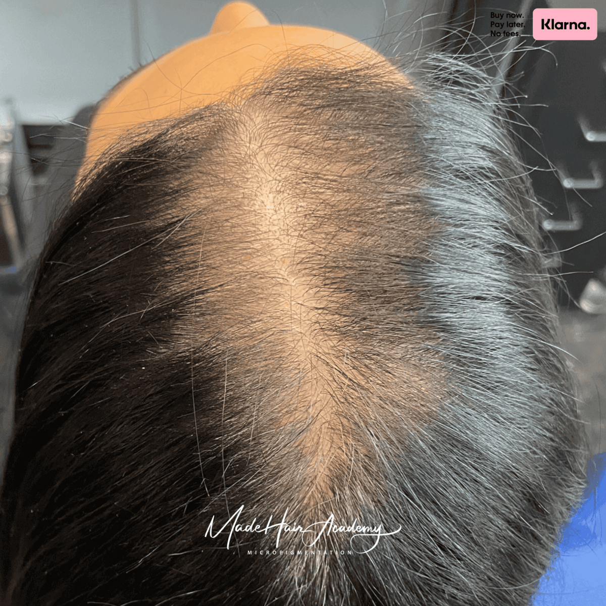 Bilden visar FÖRE resultatet av SMP för män från Göteborg, hårpigmentering behandlad hos Made Hair Academy. Hårfästet har fyllts ut med naturlig precision Genom en hårtatueringsteknik som heter Scalp Micropigmentation,