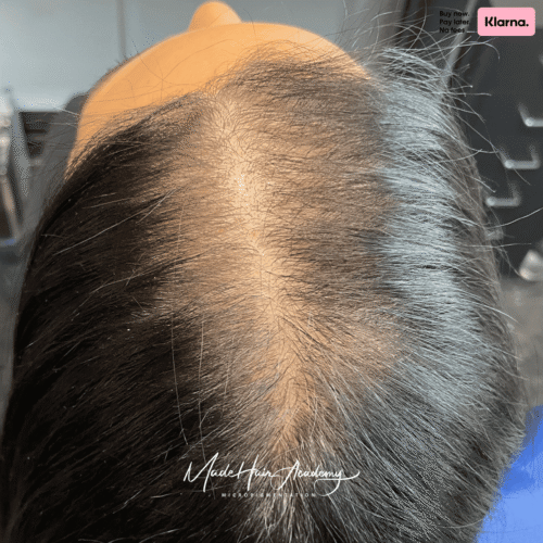 Bilden visar FÖRE resultatet av SMP för män från Göteborg, hårpigmentering behandlad hos Made Hair Academy. Hårfästet har fyllts ut med naturlig precision Genom en hårtatueringsteknik som heter Scalp Micropigmentation,