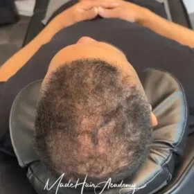 SMP hår Hårpigmentering Hårutfyllnad på man, 43år, i Stockholm – Naturligt resultat från Made Hair Academy. Utfyllnad hårbotten