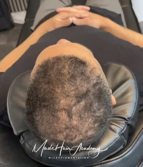 Hårpigmentering - Hårutfyllnad på man, 43år, i Stockholm – Naturligt resultat från Made Hair Academy.