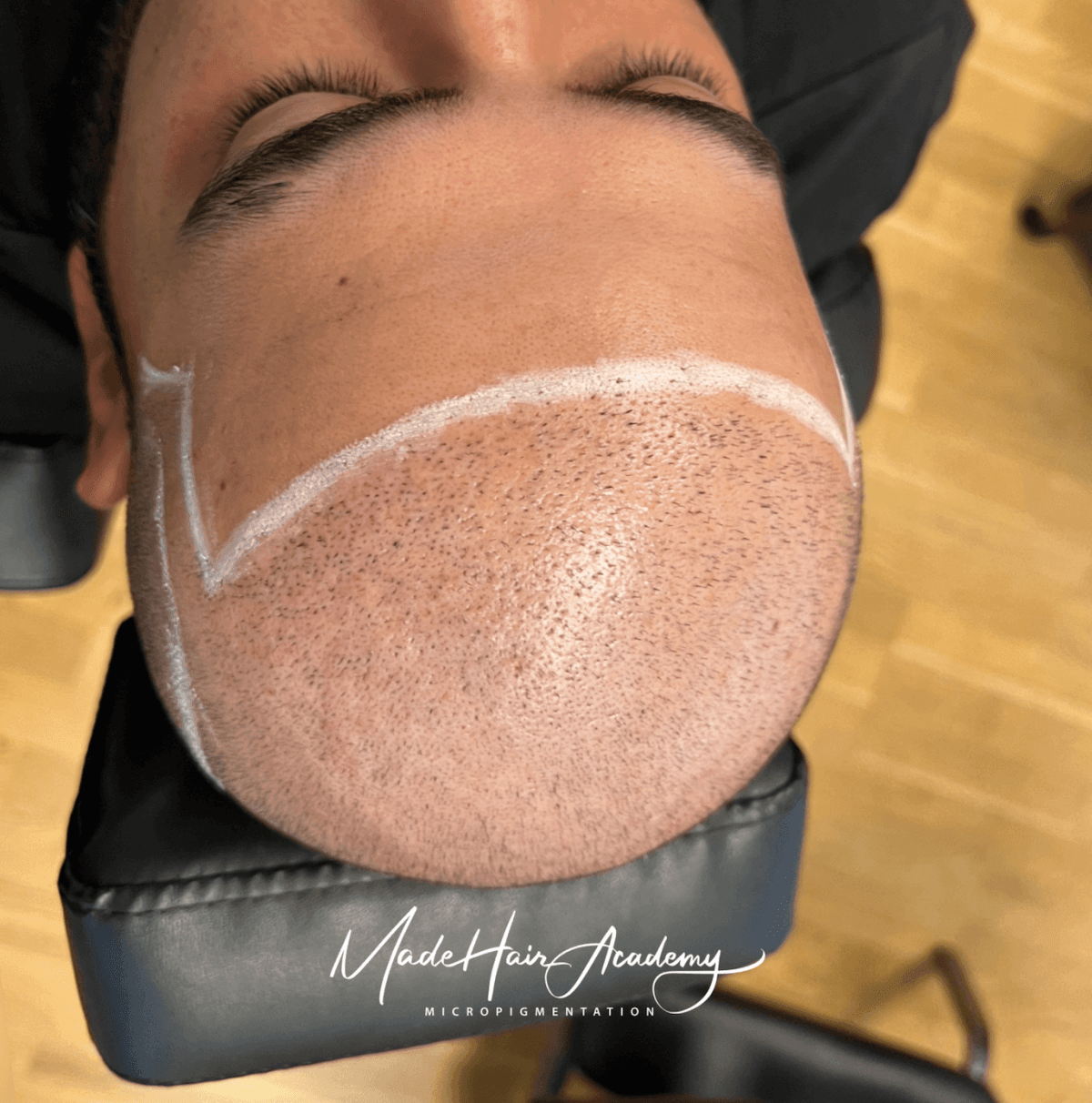 Scalp Micropigmentation - Naturlig hårlinje med smp på man, 43 år, från Uppsala – Naturligt resultat från Made Hair Academy.