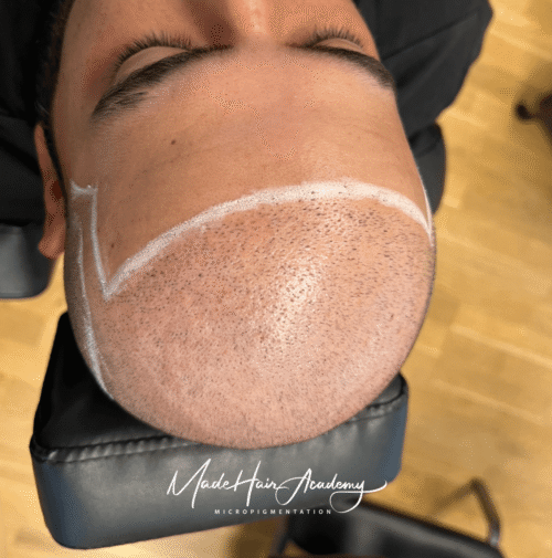 Scalp Micropigmentation - Naturlig hårlinje med smp på man, 43 år, från Uppsala – Naturligt resultat från Made Hair Academy.