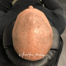 Scalp Micropigmentation, Hårpigmentering - Naturlig hårlinje med smp på man, 39 år, i Stockholm – Naturligt resultat från Made Hair Academy.