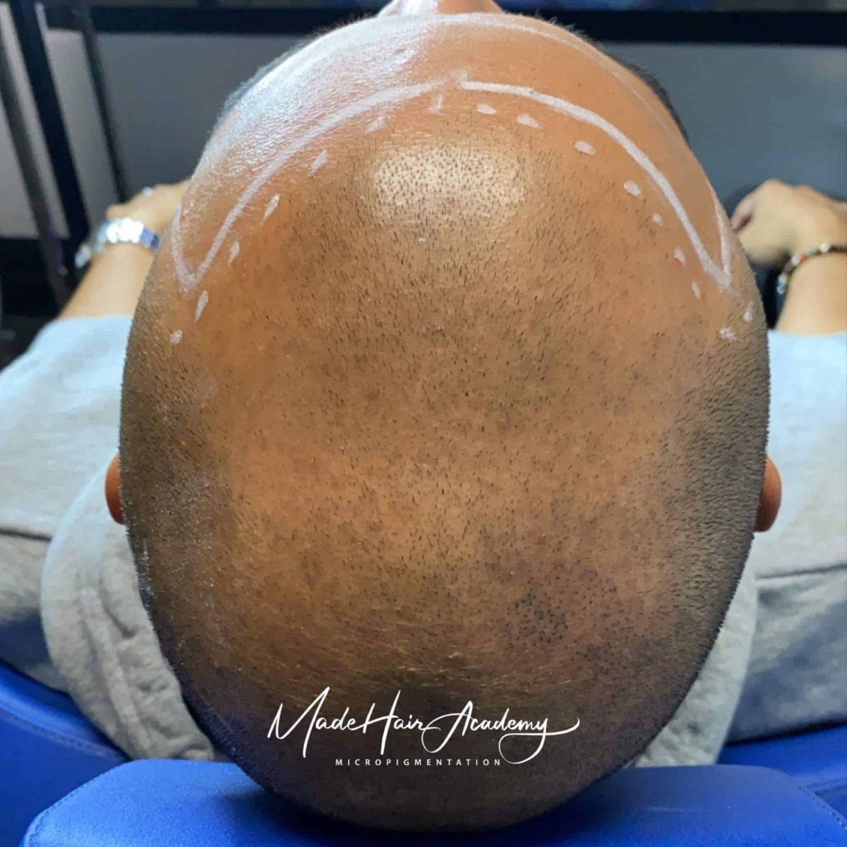 Hårpigmentering mot håravfall – Alternativ till hårtransplantation | Made Hair Academy Hårpigmentering för man 39 år i Göteborg utförd av Made Hair Academy – ledande klinik inom hårpigmentering i Sverige