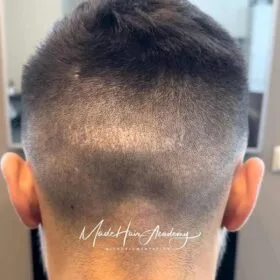 Scalp micropigmentering på man, 39 år, utförd hos Made Hair Academy i Stockholm | ledande klinik inom hårpigmentering i Sverige. Ärrbehandling efter hårtransplantation