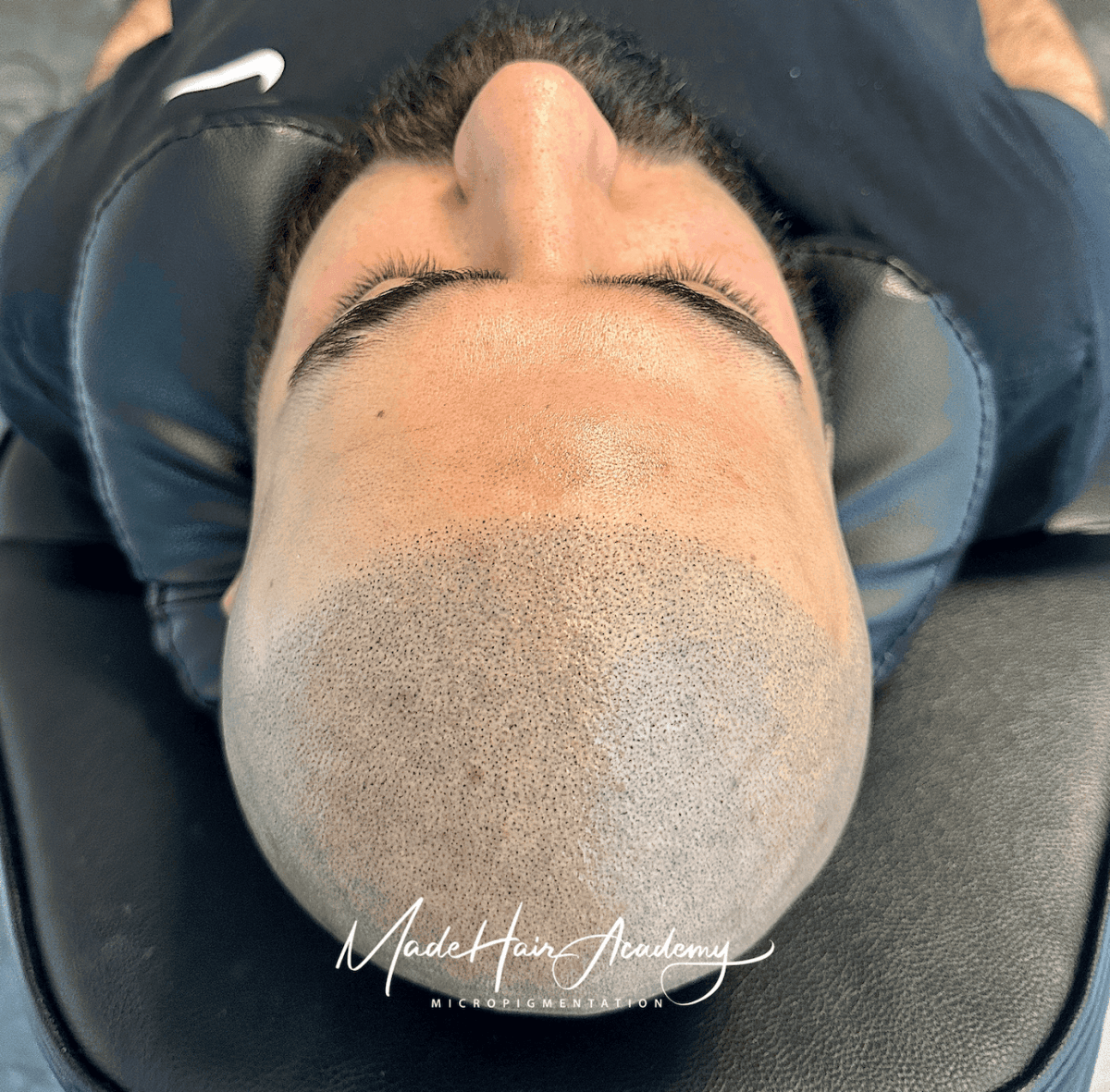 Scalp Micropigmentation, Naturlig hårlinje med smp på man, 43 år, i Göteborg –  resultat från Made Hair Academy.