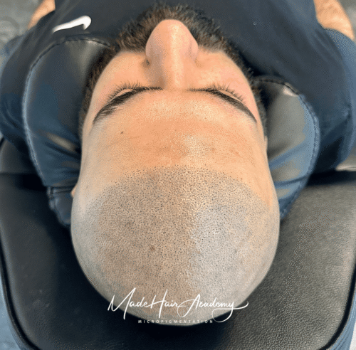 Scalp Micropigmentation, Naturlig hårlinje med smp på man, 43 år, i Göteborg –  resultat från Made Hair Academy.