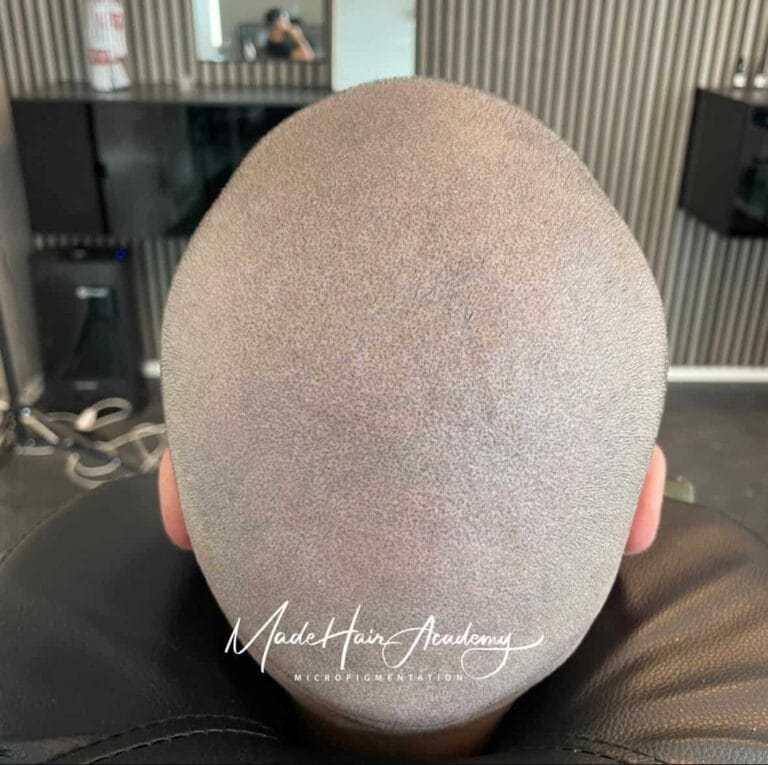 Skalpigmentering på man, 33 år, utförd hos Made Hair Academy i Göteborg – ledande klinik för diskret hårtatuering i Sverige