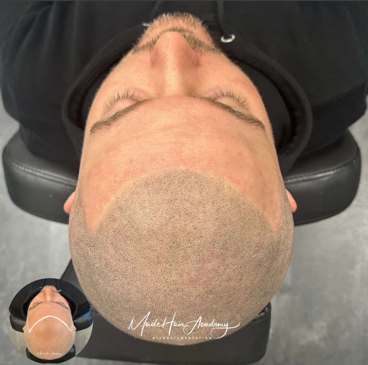 Scalp Micropigmentation, Hårpigmentering - Naturlig hårlinje med smp på man, 32 år, Från Malmö – Naturligt resultat från Made Hair Academy Göteborg