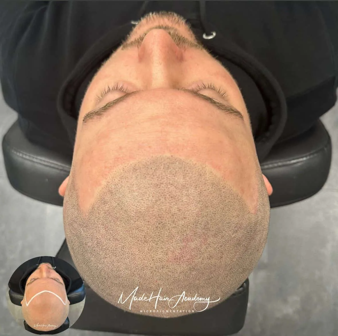 Kontakt Scalp Micropigmentation, Hårpigmentering - Naturlig hårlinje med smp på man, 32 år, Från Malmö – Naturligt resultat från Made Hair Academy Göteborg