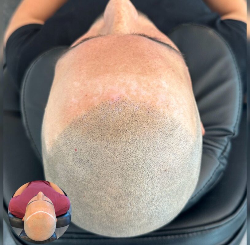 Scalp Micropigmentation Göteborg