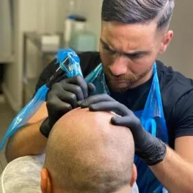 Hårpigmentering - Naturlig hårlinje med smp på man, 31 år – resultat från Made Hair Academy.