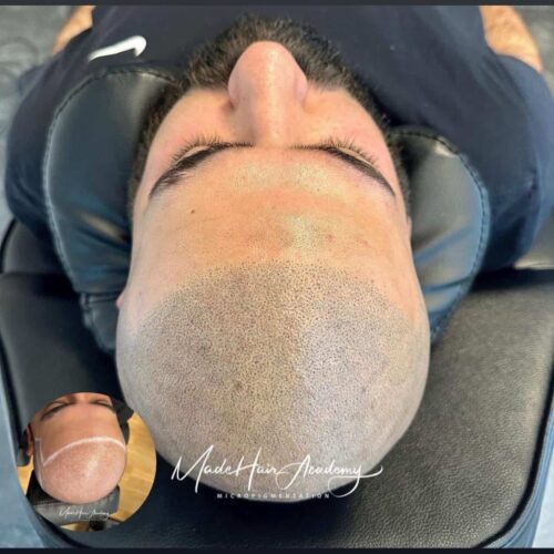 Hårpigmentering - Korrigerad hårlinje på man, 32 år, i Göteborg – Naturligt resultat från Made Hair Academy - ledande klinik för scalp micropigmentation i Sverige