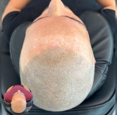 Scalp Micropigmentation, Hårpigmentering - smp på man, 32 år, i Göteborg – Naturligt resultat från Made Hair Academy.