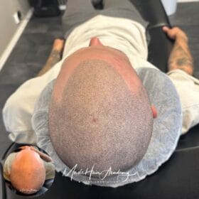 Hårpigmentering för man, 31 år, utförd hos Made Hair Academy Göteborg – ledande klinik för hårpigmentering i Sverige
