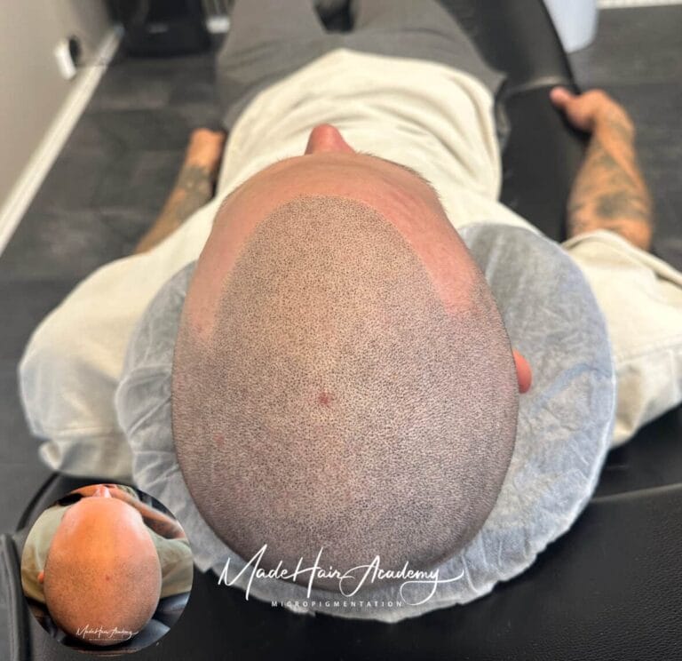 Hårpigmentering för man, 31 år, utförd hos Made Hair Academy Göteborg – ledande klinik för hårpigmentering i Sverige