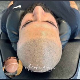 Scalp micropigmentation för man, 31 år - utförd hos Made Hair Academy Göteborg – ledande klinik för scalp micropigmentation i Sverige