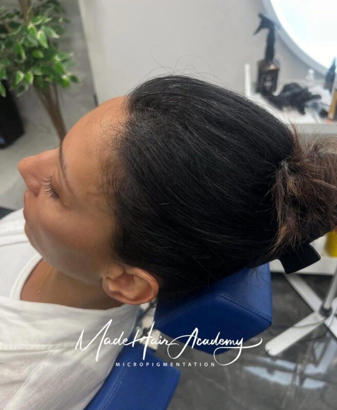 Scalp Micropigmentation by Made Hair Academy