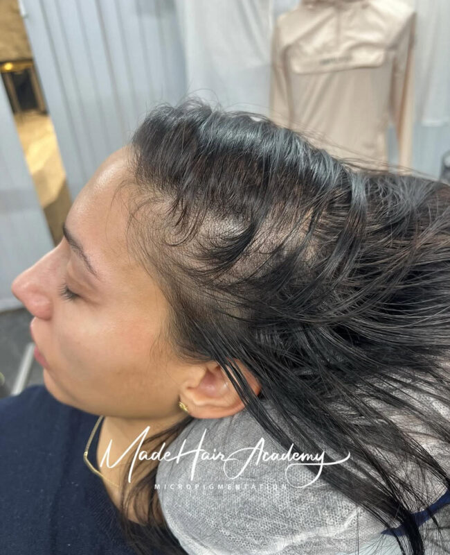 Scalp Micropigmentation by Made Hair Academy