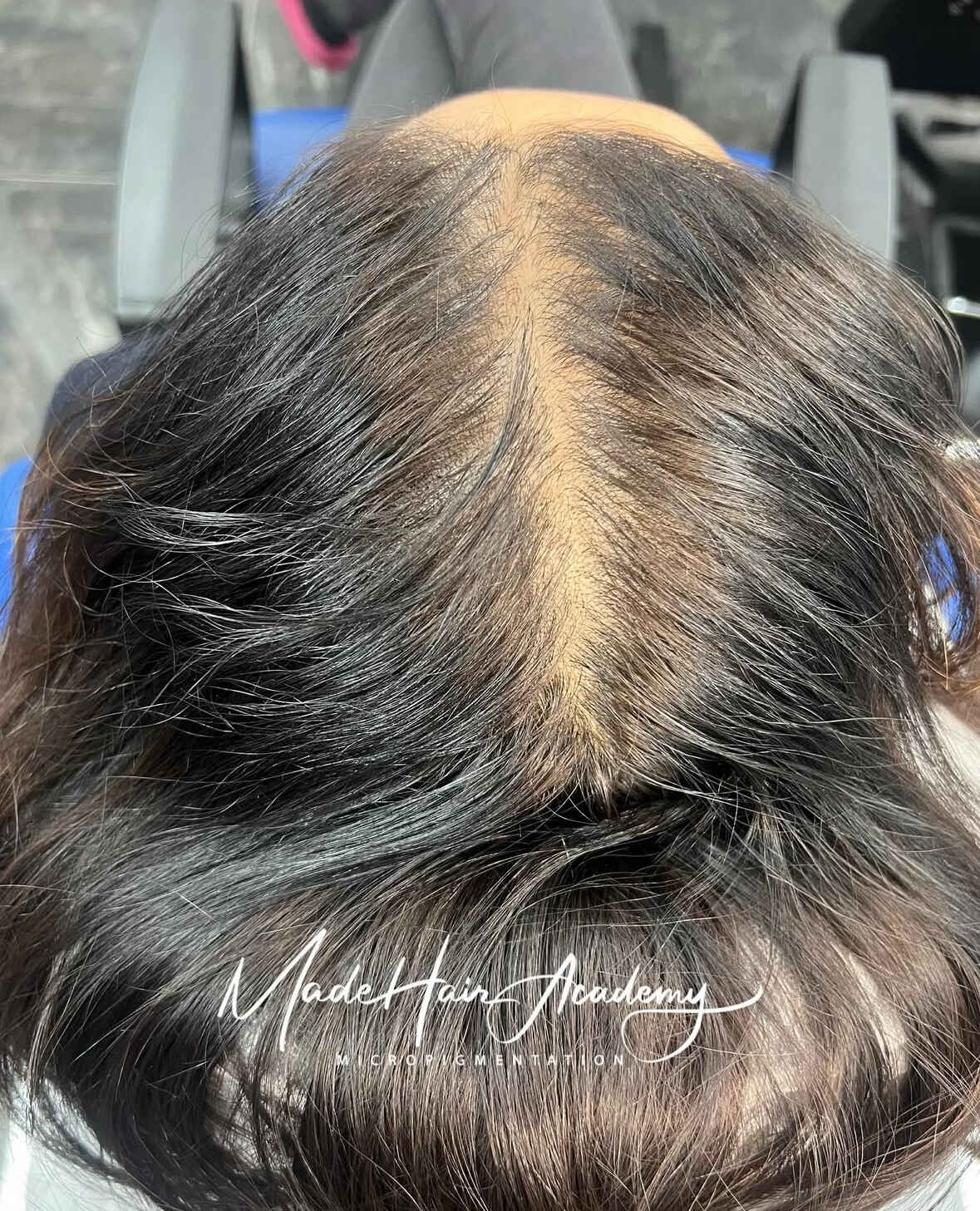 Scalp Micropigmentation by Made Hair Academy