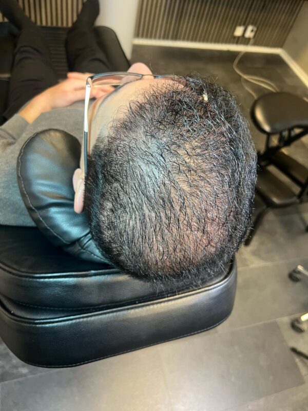 Scalp Micropigmentation by Made Hair Academy