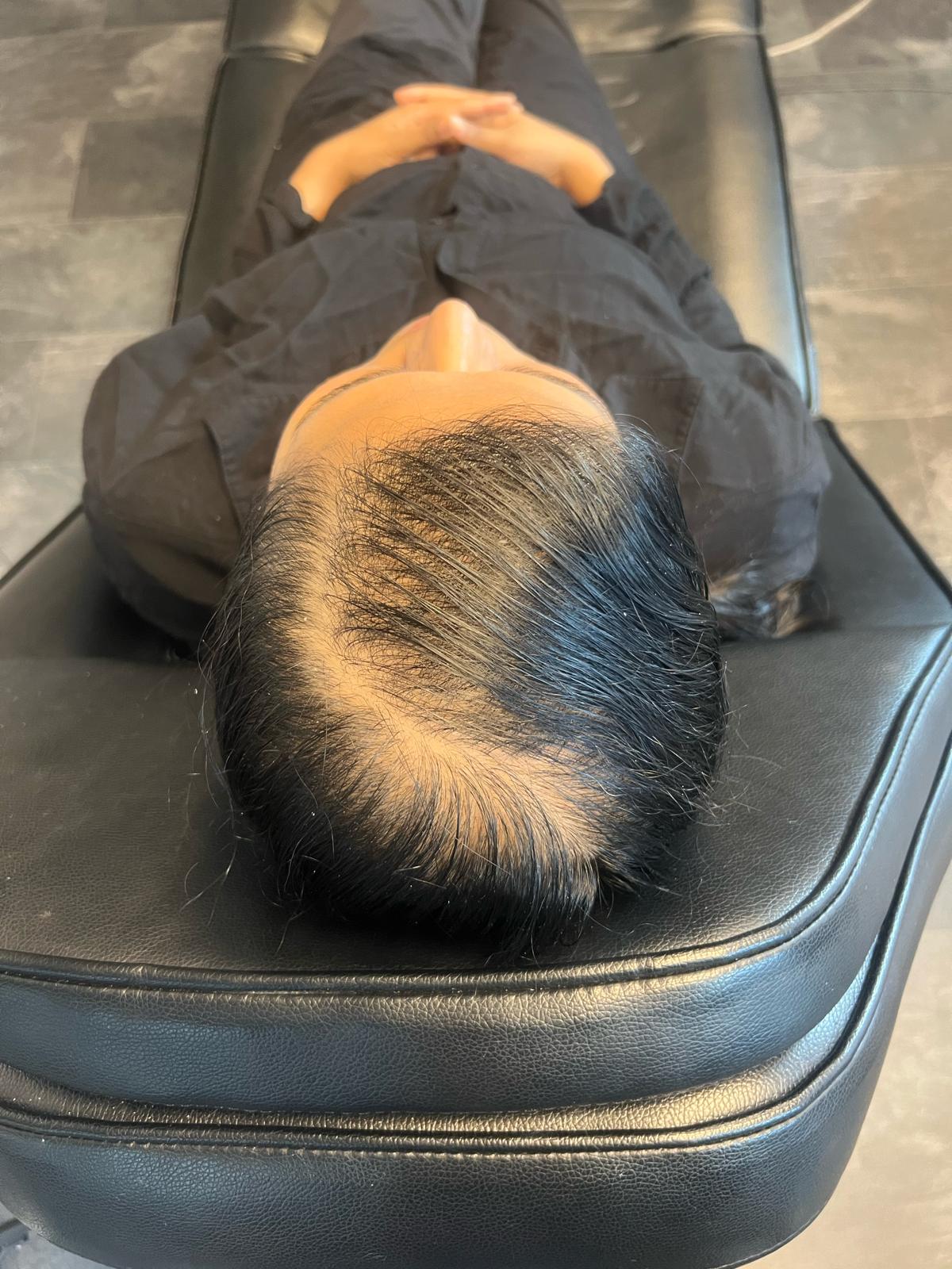 Scalp Micropigmentation by Made Hair Academy