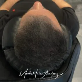 Scalp Micropigmentation för män Hårtattoo på man, 44 år, utförd hos Made Hair Academy Stockholm – diskret och professionell hårtatuering i Sverige