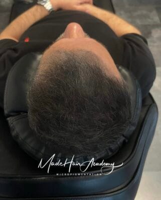 Scalp Micropigmentation för män Hårtattoo på man, 44 år, utförd hos Made Hair Academy Stockholm – diskret och professionell hårtatuering i Sverige