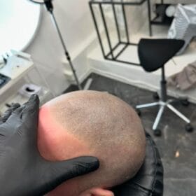 Hårtattoo på man, 49 år, utförd hos Made Hair Academy Göteborg – specialist på diskret hårtatuering i Sverige