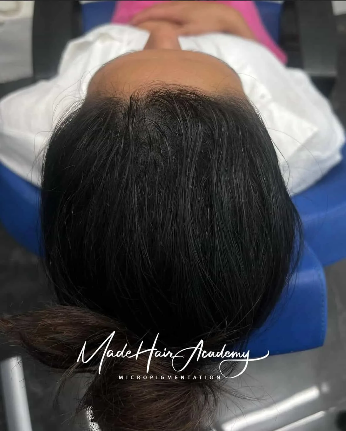 Hårpigmentering på kvinna, 34 år, utförd hos Made Hair Academy Stockholm – klinik med spetskompetens inom SMP i Sverige