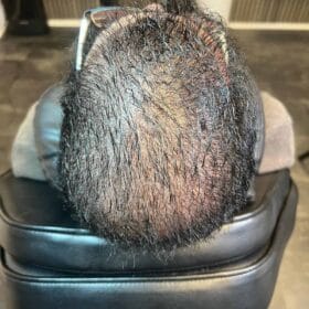 SMP Göteborg Scalp Micropigmentation, Hårpigmentering - Hårutfyllnad på man, 28 år, i Stockholm – Naturligt resultat från Made Hair Academy.