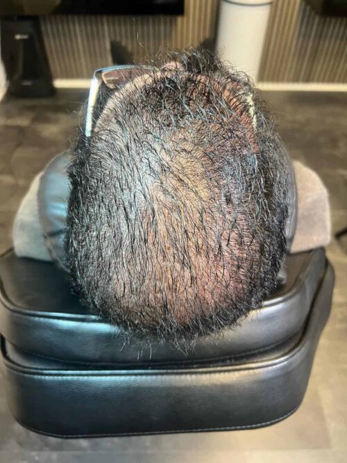 Scalp Micropigmentation, Hårpigmentering - Hårutfyllnad på man, 28 år, i Stockholm – Naturligt resultat från Made Hair Academy.