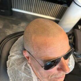 Hårpigmentering på man, 36 år, utförd hos Made Hair Academy Stockholm – etablerad studio för diskret hårtatuering i Sverige