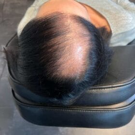 Scalp Micropigmentation, Hårpigmentering - Hårutfyllnad på kvinna, 28 år, i Stockholm – Naturligt resultat från Made Hair Academy.