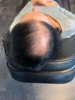 Alopecia Areata Behandling med Scalp Micropigmentation, Hårpigmentering - Hårutfyllnad på kvinna, 28 år, i Stockholm – Naturligt resultat från Made Hair Academy.