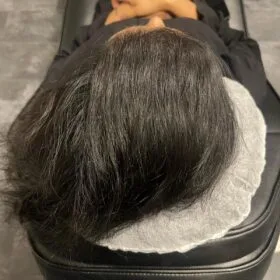 Scalp micropigmentation kvinnor