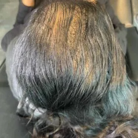 Scalp micropigmentation på kvinna, 38 år, utförd hos Made Hair Academy Stockholm – toppval för kvinnlig SMP i Sverige