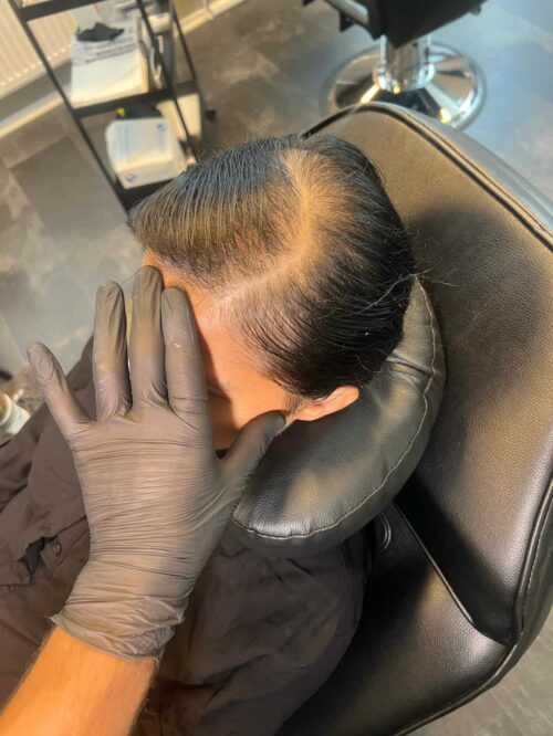 Scalp micropigmentation på kvinna, 42 år, utförd hos Made Hair Academy Stockholm – klinik med spetskompetens inom hårtatuering i Sverige