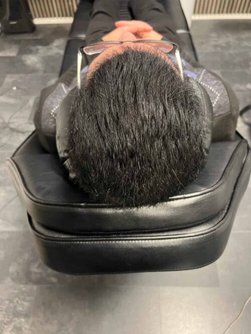 Scalp micropigmentation på man, 36 år, utförd hos Made Hair Academy Stockholm – ledande klinik inom scalp micropigmentation i Sverige