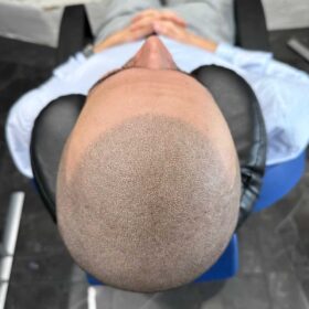 Scalp Micropigmentation på man, 37 år, utförd hos Made Hair Academy Göteborg – ledande klinik för SMP i Sverige