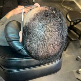 Scalp micropigmentation på man, 37 år, utförd hos Made Hair Academy – specialist på hårtatuering för män i Sverige