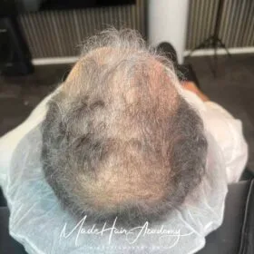 Hårtatuerings behandling. Scalp Micropigmentation för män SMP-hår på man, 44 år, utförd hos Made Hair Academy Stockholm – ledande inom scalp micropigmentation i Sverige