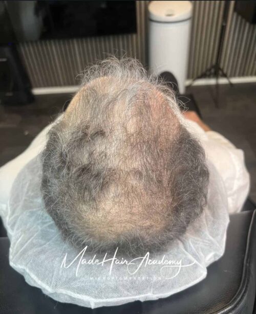 SMP-hår på man, 44 år, utförd hos Made Hair Academy Stockholm – ledande inom scalp micropigmentation i Sverige